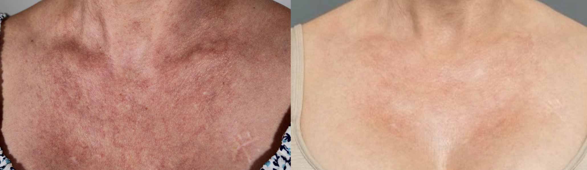 BBL chest vein removal cutis dermatology