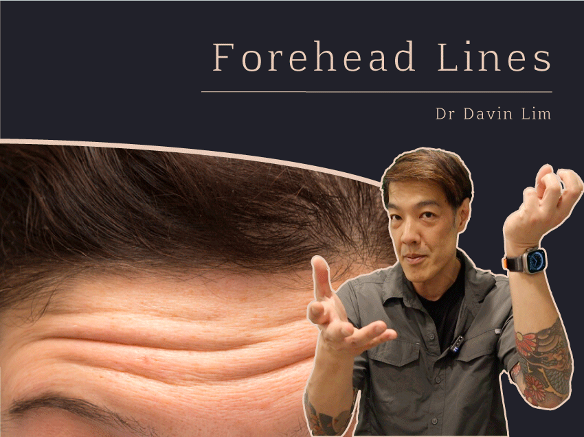 Forehead lines wrinkles brisbane dr davin lim