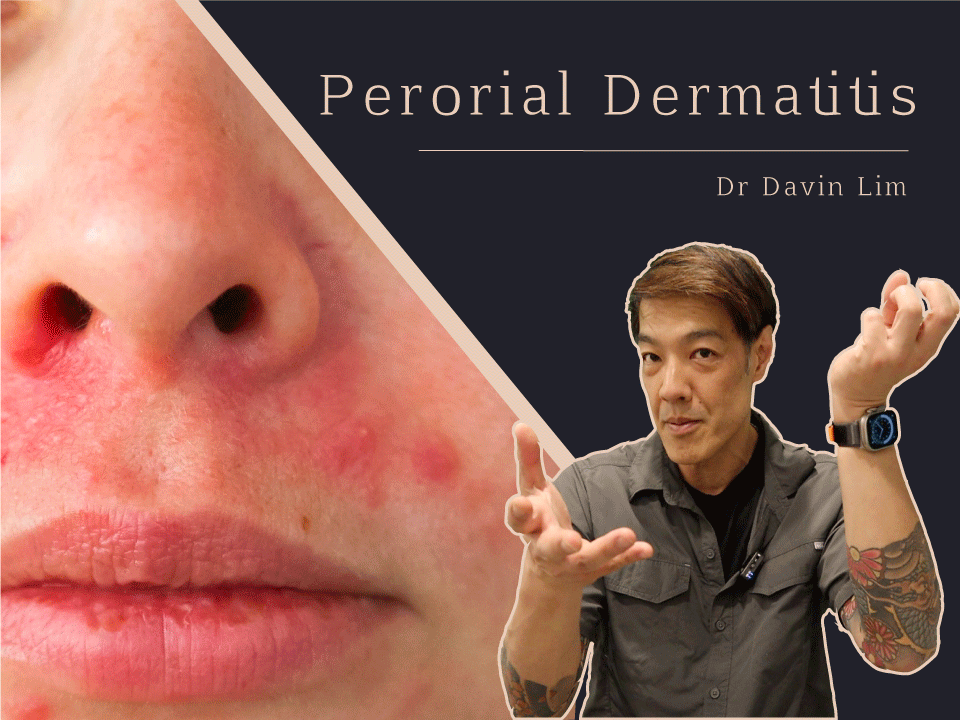 Perorial Dermatitis Dr Davin Lim Brisbane