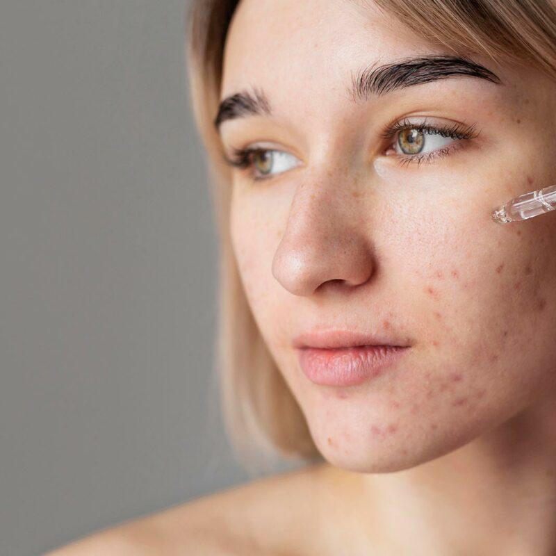 Best DIY acne scar treatments