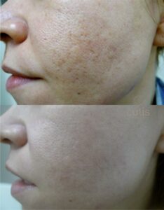 best enlarged pore treatment brisbane