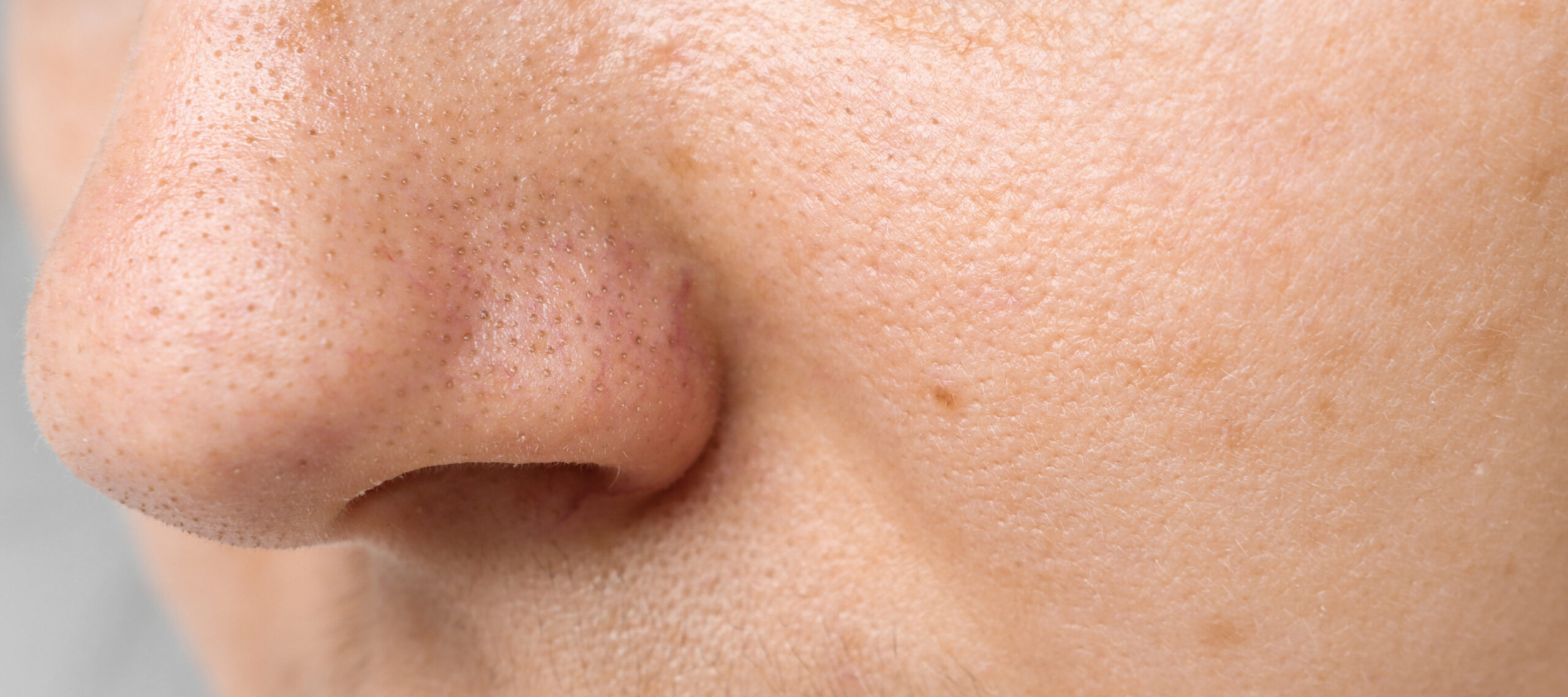 Home Remedies for Enlarged Pores