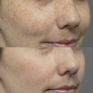 freckle removal treatment brisbane cutis dermatolgy