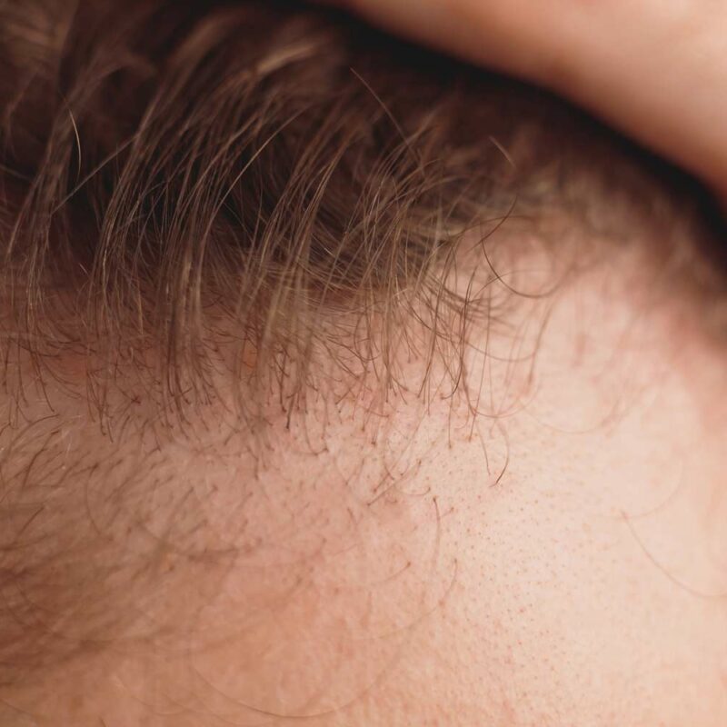 frontal fibrosing alopecia treatments