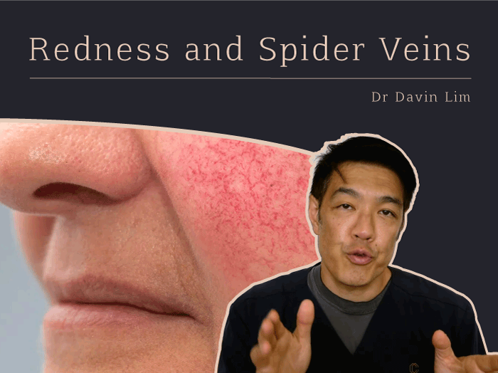 Redness Spider Veins Rosacea Dr Davin Lim