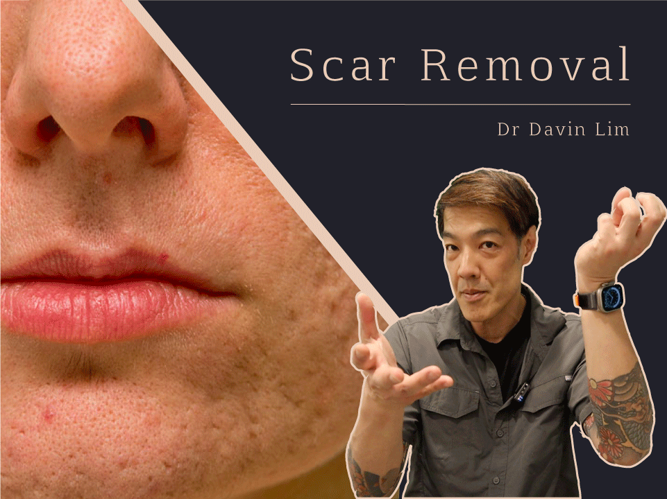 Scar Removal Dr Davin Lim Brisbane