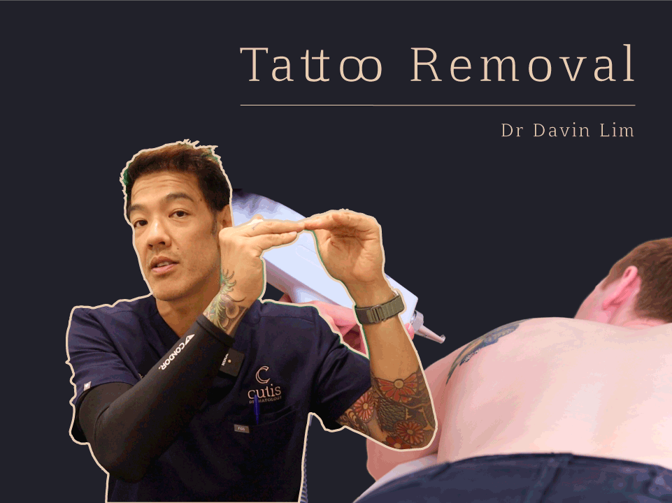 Tattoo Removal Brisbane Dr Davin Lim