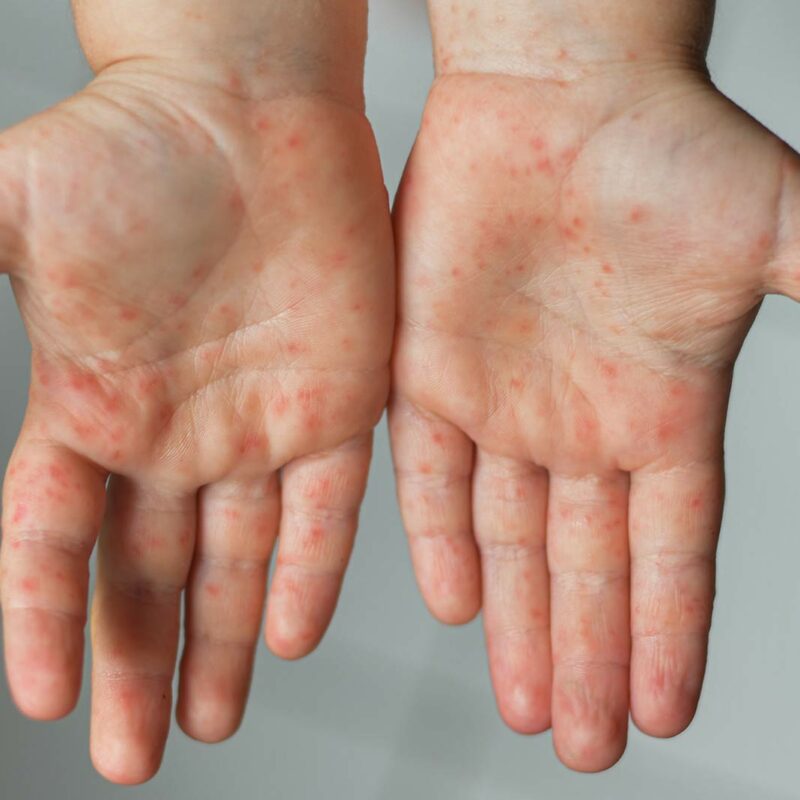 how to treat hand eczema