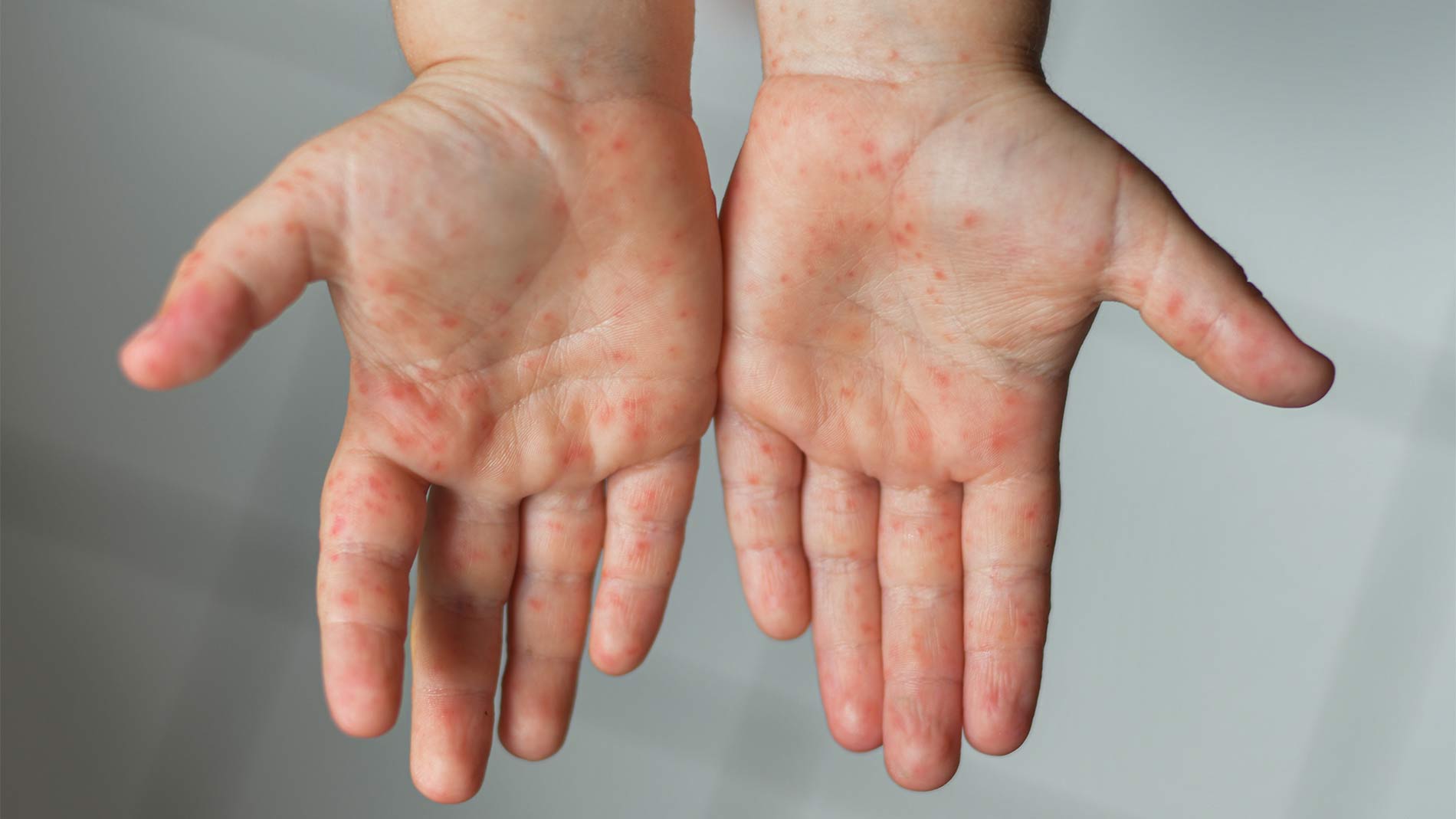 How to treat hand eczema