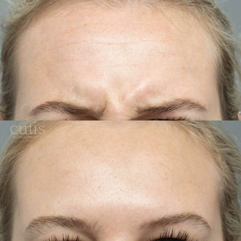 Best Frown Line Treatment Brisbane | Cutis Dermatology