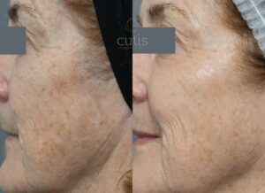 fractional high density laser Cutis Clinic