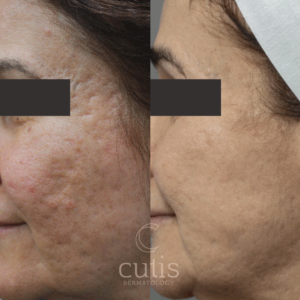 Acne Scars - Cutis Dermatology