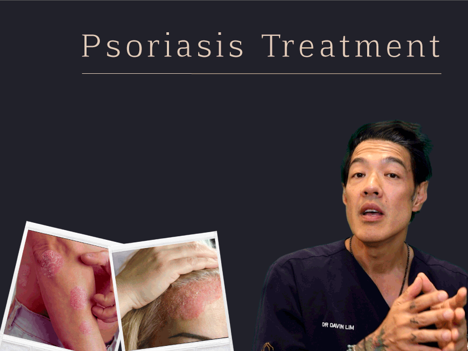 Psoriasis treatment Dr Davin Lim Brisbane