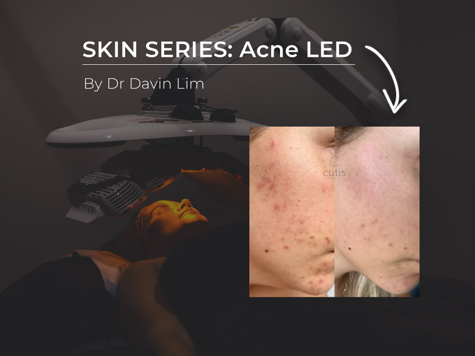 acne led treatment brisbane cutis dermatology dr davin lim