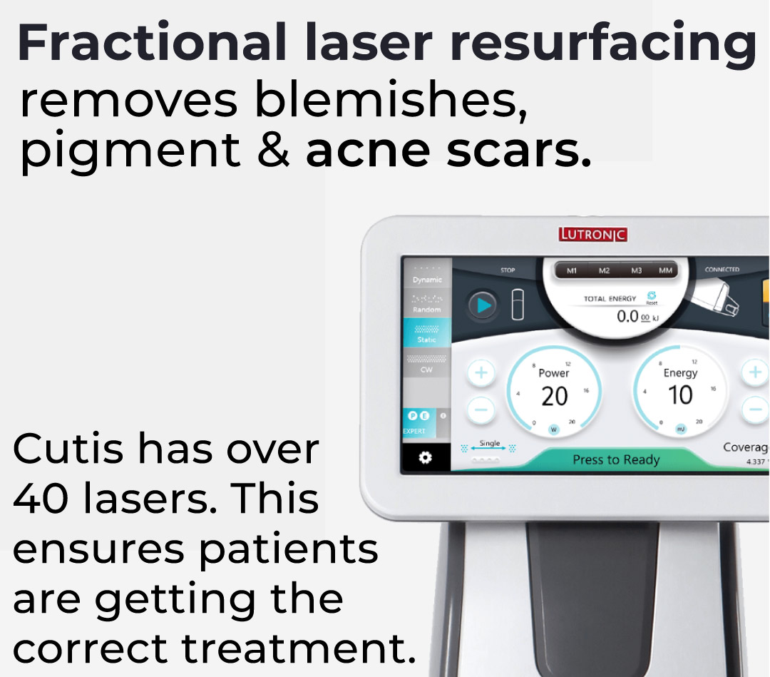 acne scar revision brisbane 1 acne scar revision brisbane 1
