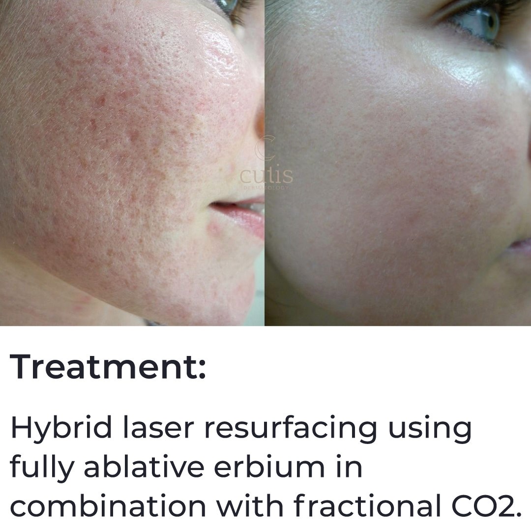 acne scar revision brisbane 4 acne scar revision brisbane 4