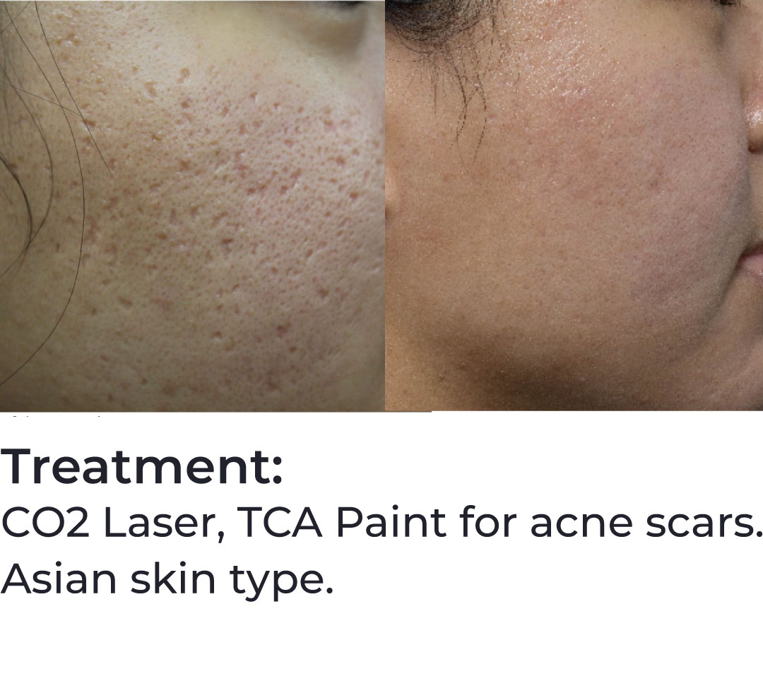 acne scar revision brisbane 44 acne scar revision brisbane 44