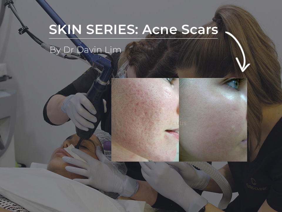 acne scar treatment brisbane cutis dermatology