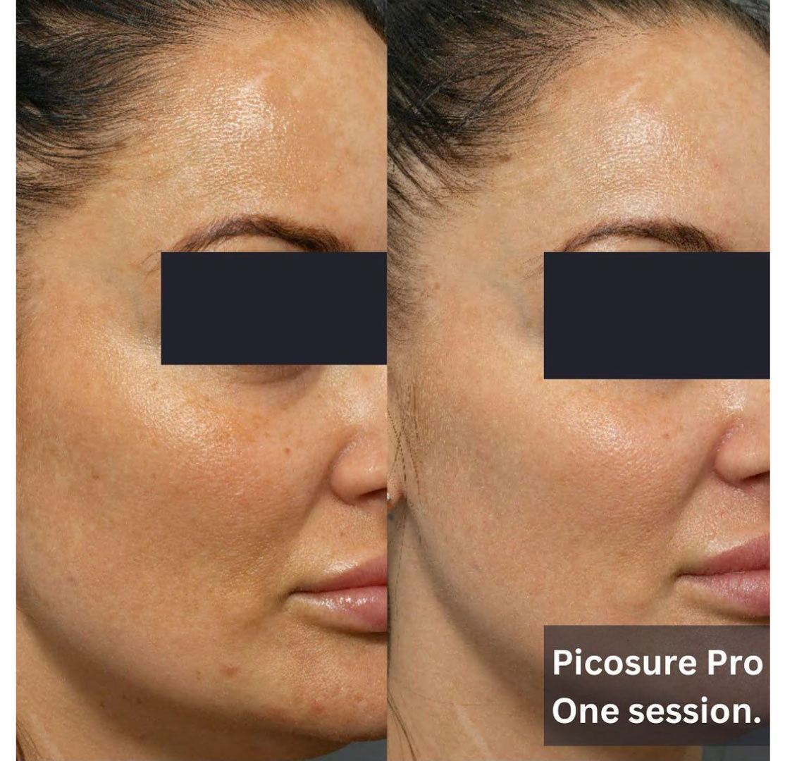 Best Melasma Laser Treatment Package Brisbane