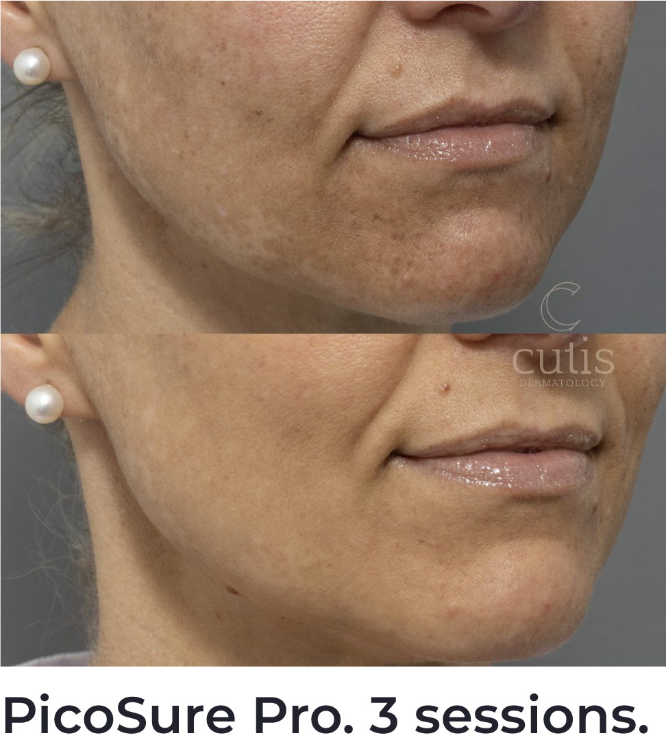 Best Melasma Laser Treatment Package Brisbane