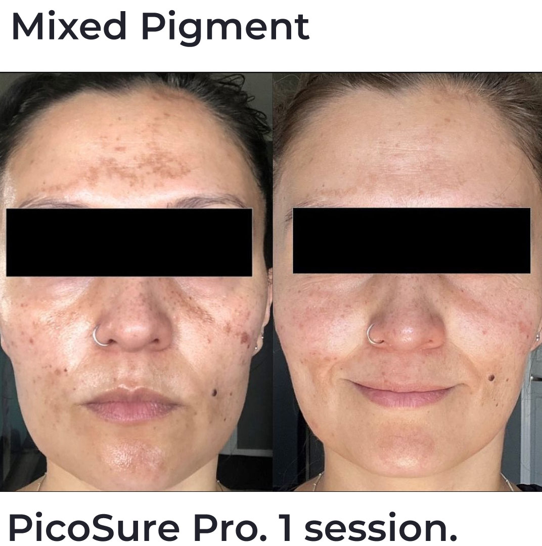 Best Melasma Laser Treatment Package Brisbane