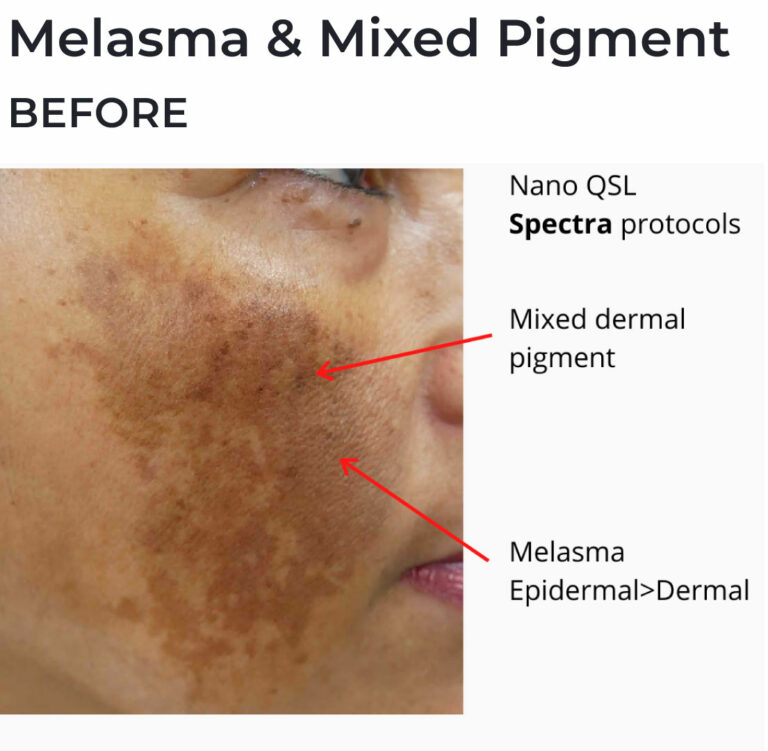 Best Melasma Treatment Packages Brisbane Cutis Dermatology