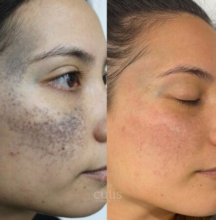 ota birthmark removal before after