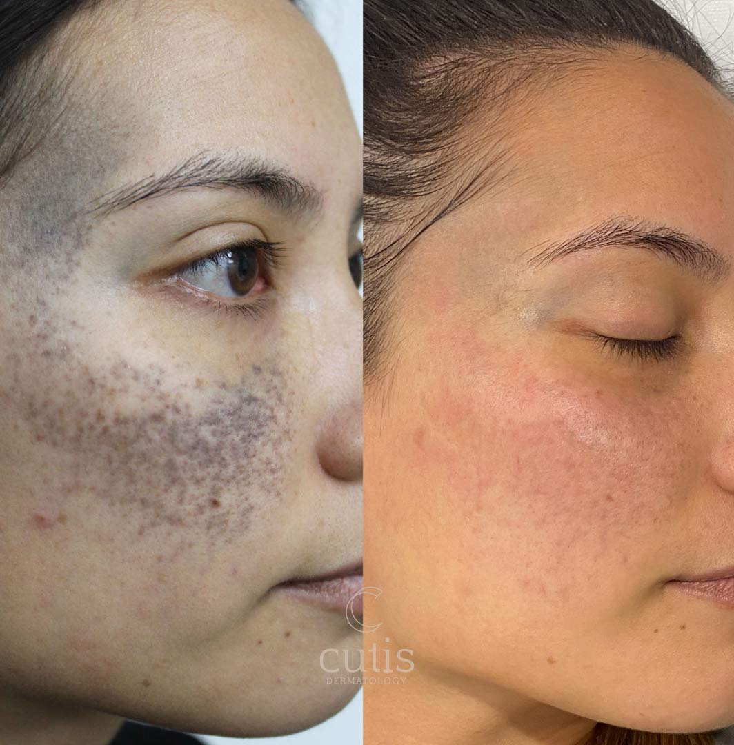 Ota Birthmark Cutis Dermatology