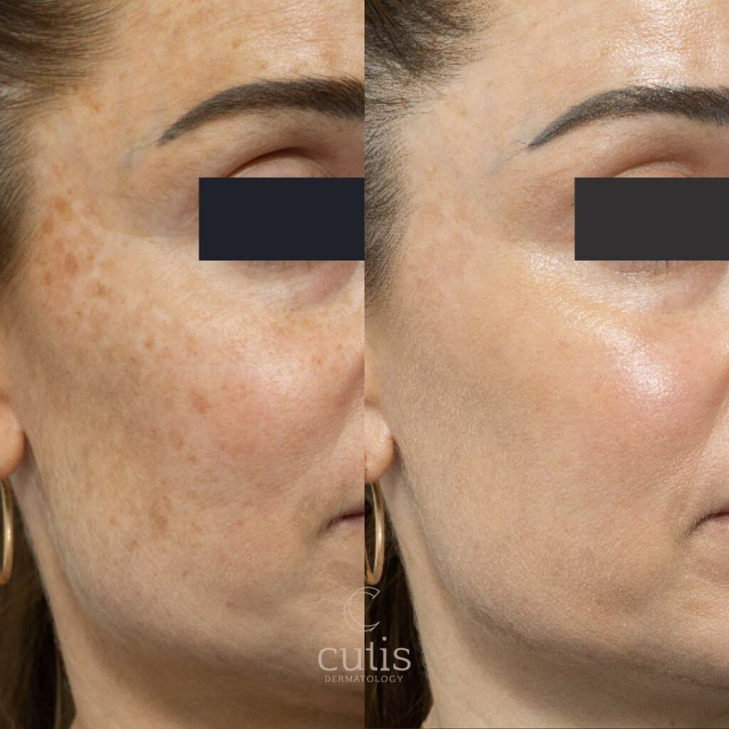 Picosure Pro Laser Treatment Brisbane Cutis Dermatology