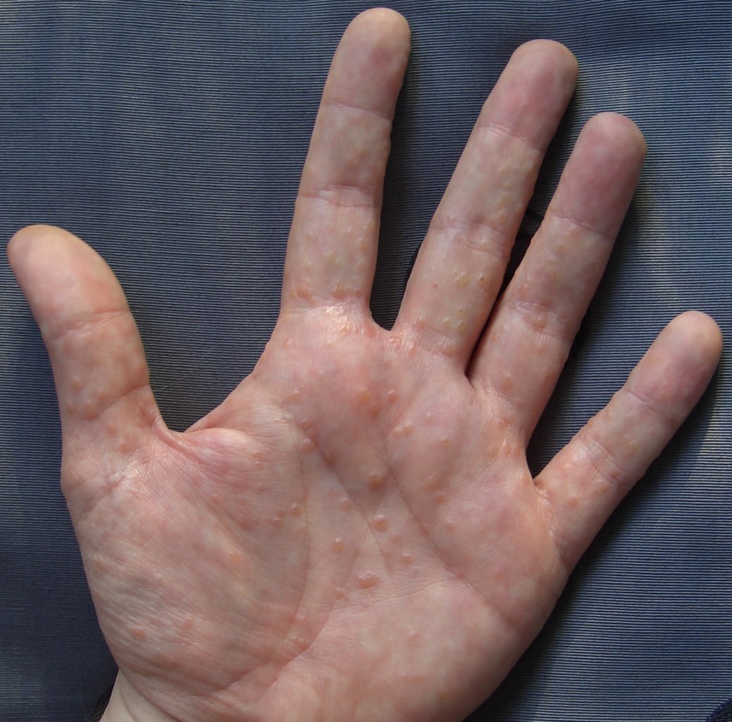 Dyshidrotic Eczema: Blisters & Cracked Skin