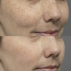 freckle removal treatment brisbane cutis
