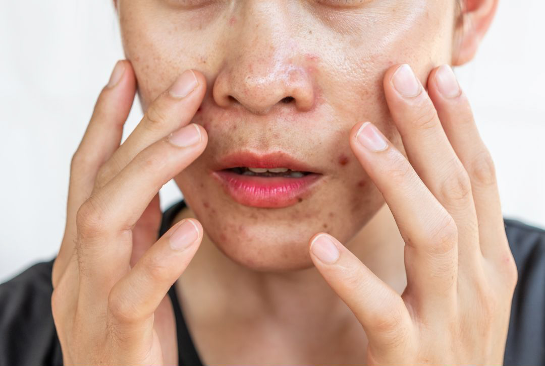Do I Need To Moisturise If I Have Oily Or Combination Skin?