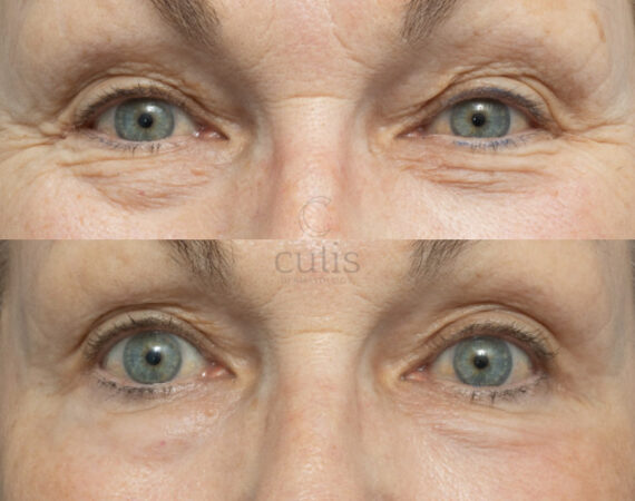 eye wrinkle removal brisbane