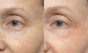 co2 laser eye rejuvenation