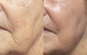 co2 laser resurfacing