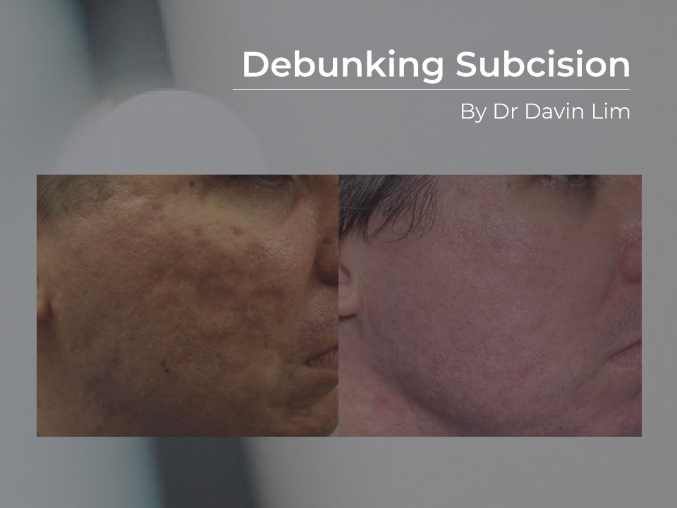 acne scar subcision brisbane