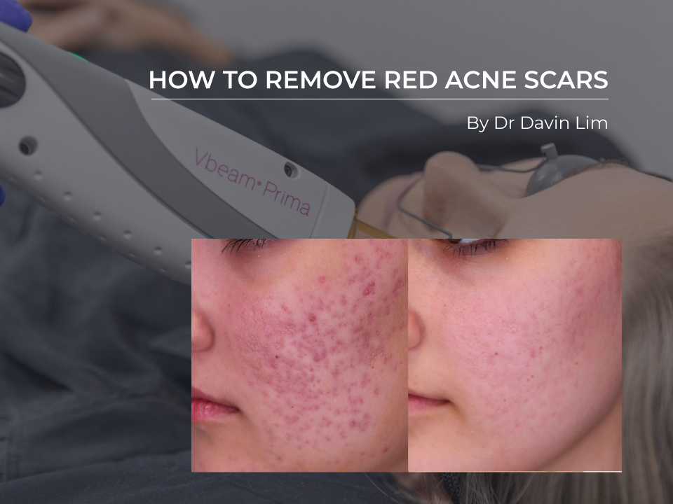 best red acne scar treatment near in brisbane