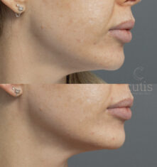 hifu double chin treatment