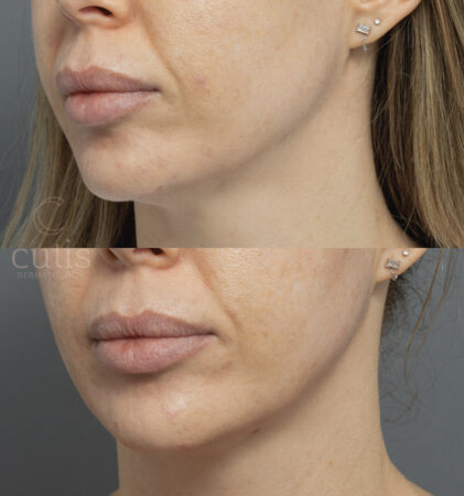 hifu ultherapy before after