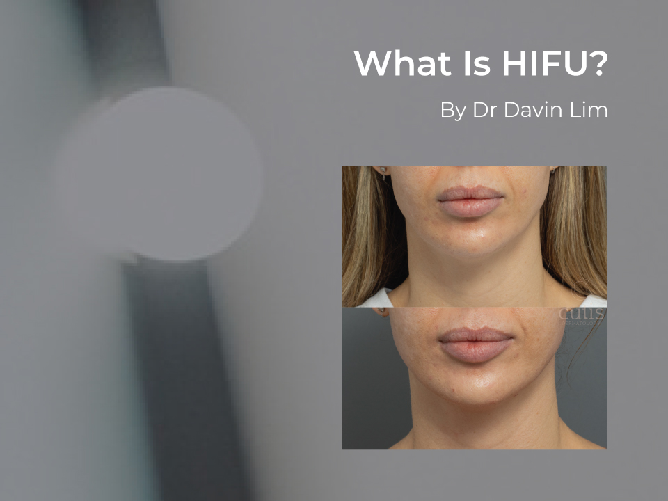 what is hifu ultherapy