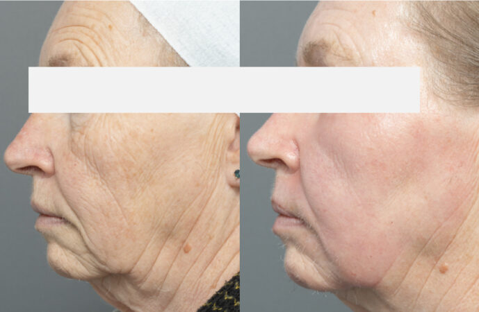 wrinkle removing treatments laser