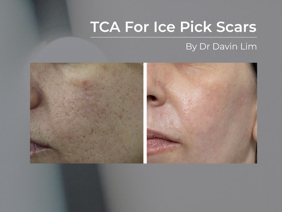 TCA acne scars