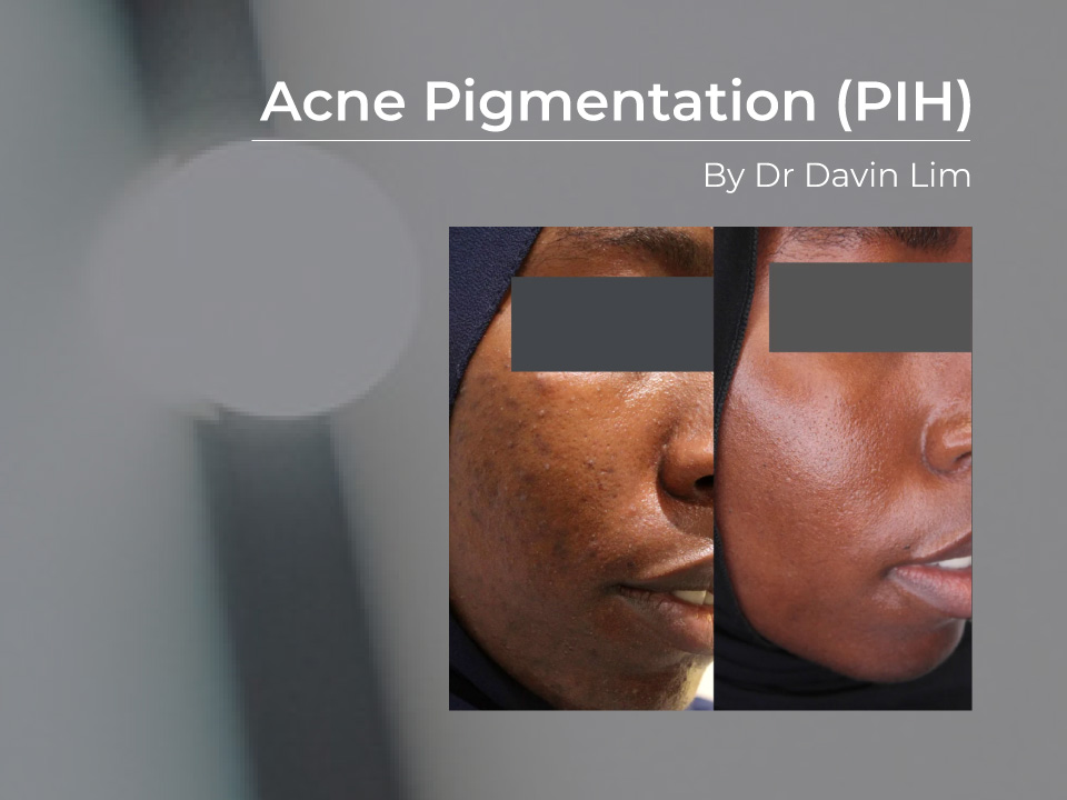 acne pigmentation pih treatment