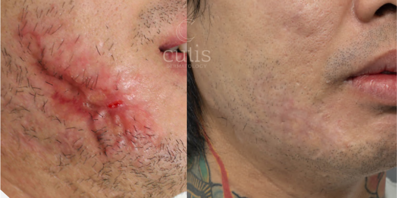 atrophic scar face removal