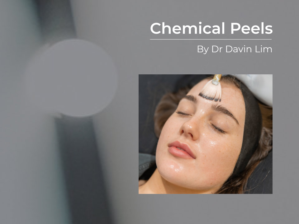 best chemical peels for me