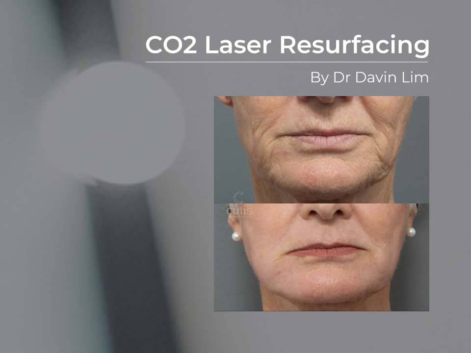 CO2 Laser Resurfacing: Types, Effects, Cost, Aftercare