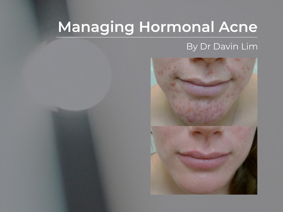 hormonal pcos acne treatments