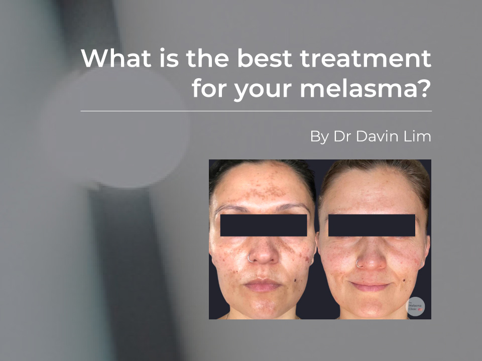 how to choose right treatment for melasma