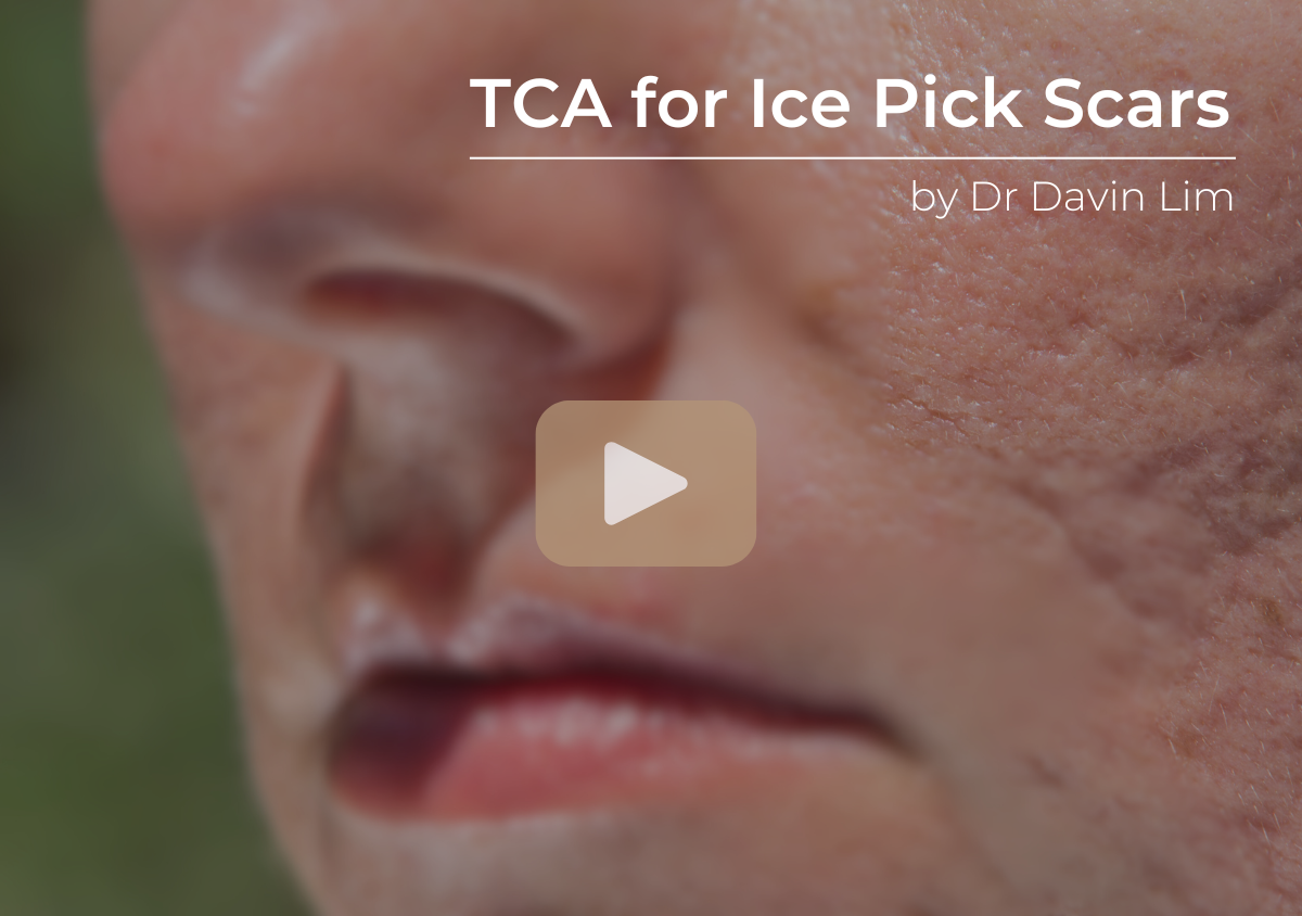 TCA for Ice Pick Acne Scars