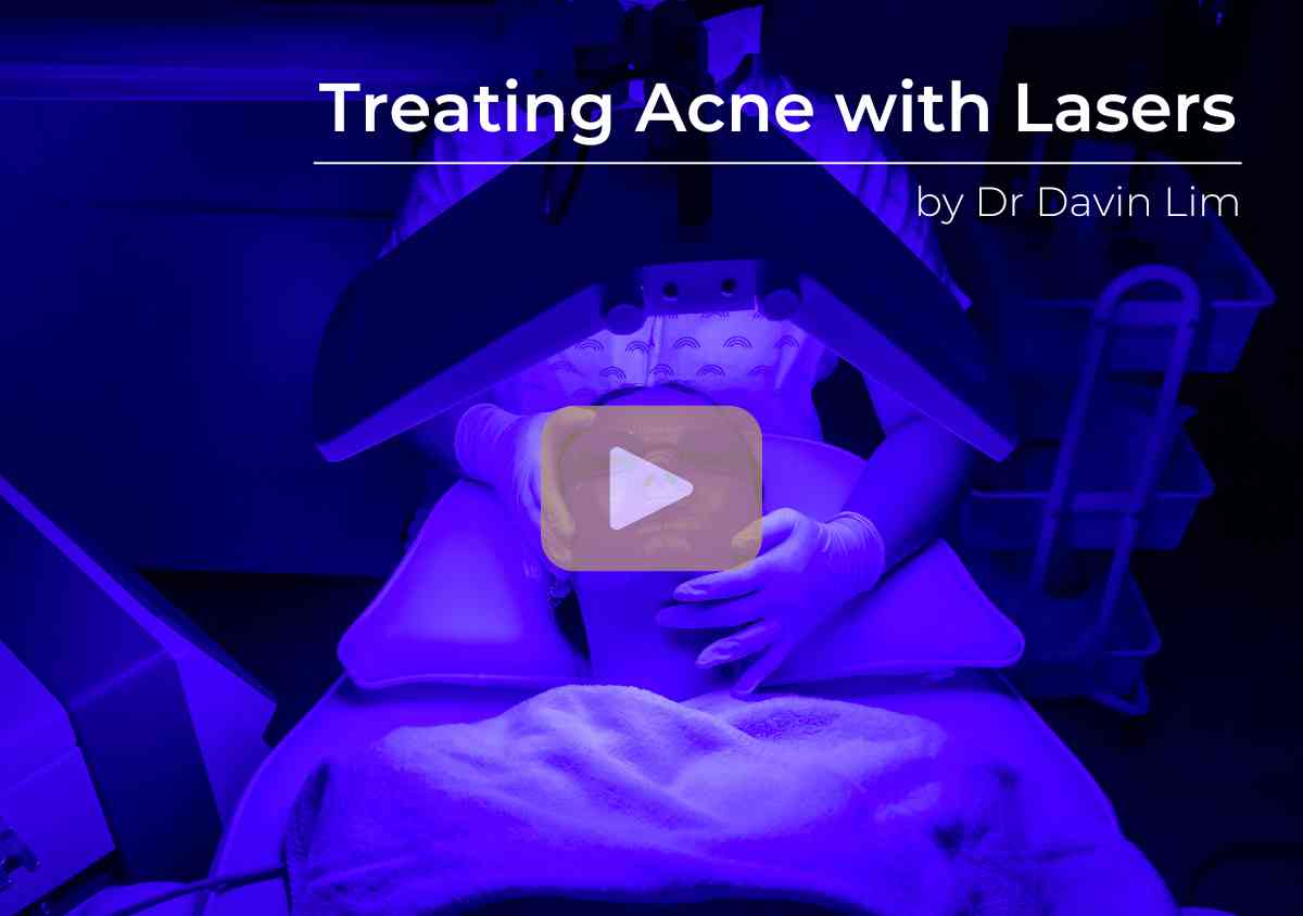 treating acne with laser